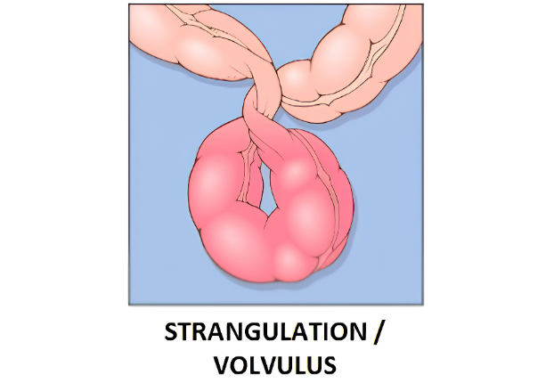 Strangulated hernia progression diagram